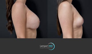 Breast Explant Before & After Gallery - Patient 142194 - Image 4