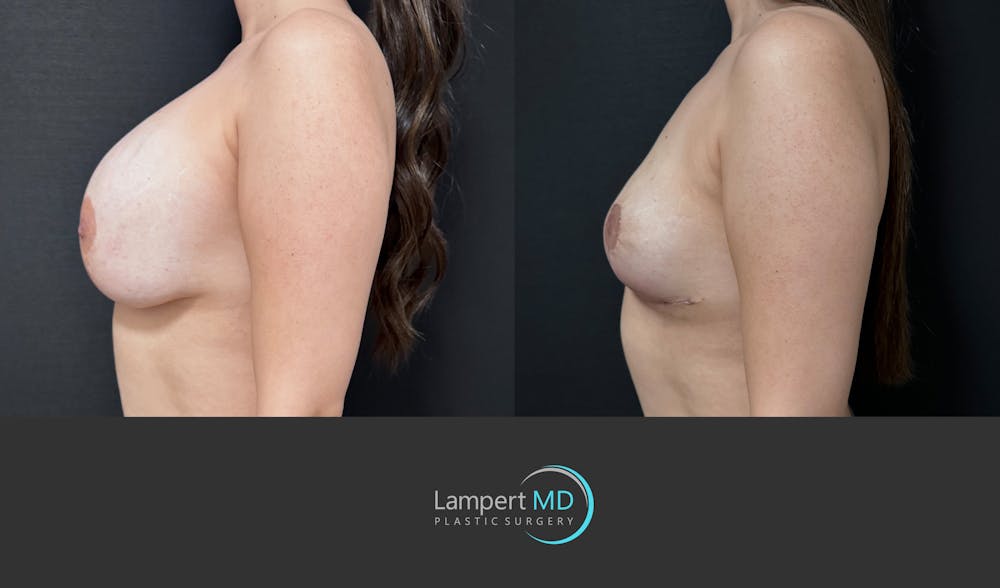 Breast Explant Before & After Gallery - Patient 142194 - Image 5
