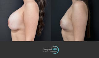 Breast Explant Before & After Gallery - Patient 142194 - Image 5