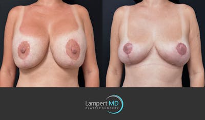Breast Explant Before & After Gallery - Patient 357741 - Image 1