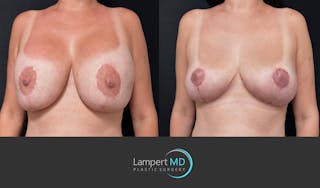 Breast Explant Before & After Gallery - Patient 357741 - Image 2