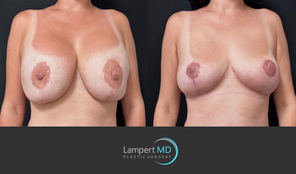Breast Explant Before & After Gallery - Patient 357741 - Image 3