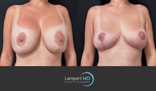 Breast Explant Before & After Gallery - Patient 357741 - Image 3