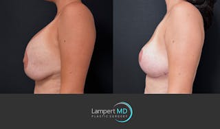 Breast Explant Before & After Gallery - Patient 357741 - Image 4