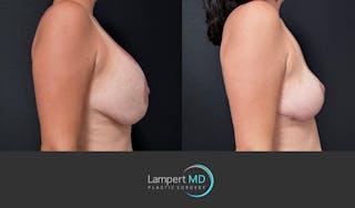 Breast Explant Before & After Gallery - Patient 357741 - Image 5