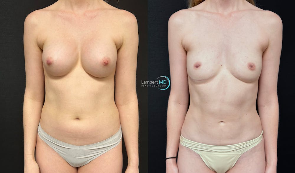 Breast Explant Before & After Gallery - Patient 391956 - Image 2