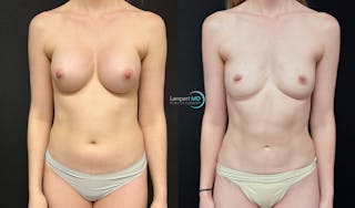 Breast Explant Before & After Gallery - Patient 391956 - Image 2
