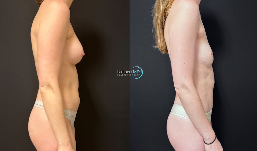Breast Explant Before & After Gallery - Patient 391956 - Image 4