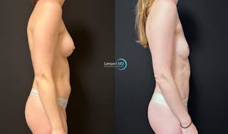 Breast Explant Before & After Gallery - Patient 391956 - Image 4