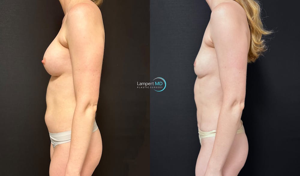 Breast Explant Before & After Gallery - Patient 391956 - Image 5