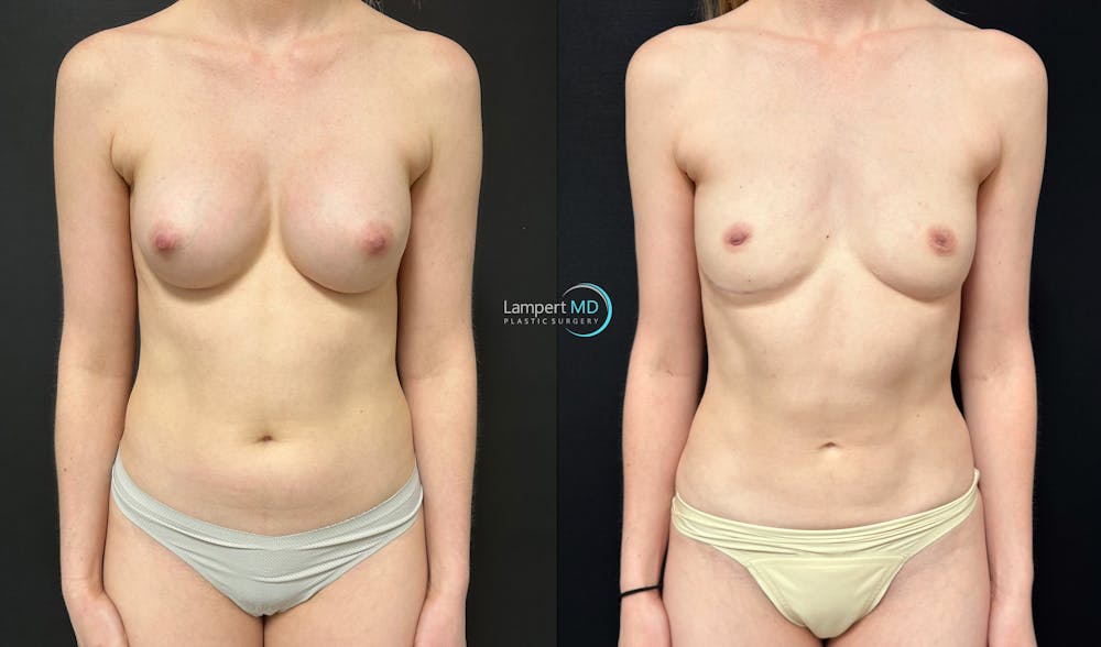 Breast Explant Before & After Gallery - Patient 391956 - Image 1