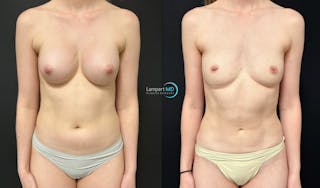 Breast Explant Before & After Gallery - Patient 391956 - Image 1