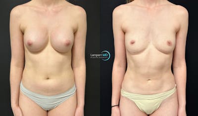 Breast Explant Before & After Gallery - Patient 391956 - Image 1