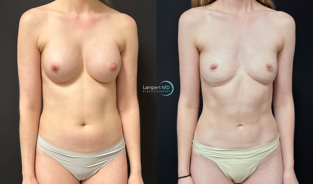 Breast Explant Before & After Gallery - Patient 391956 - Image 3
