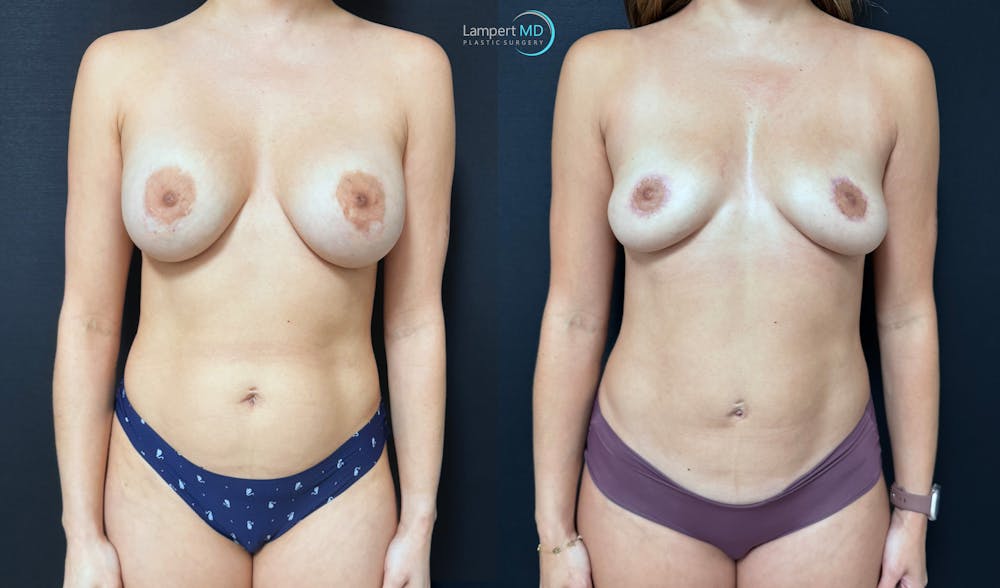 Breast Explant Before & After Gallery - Patient 420516 - Image 1