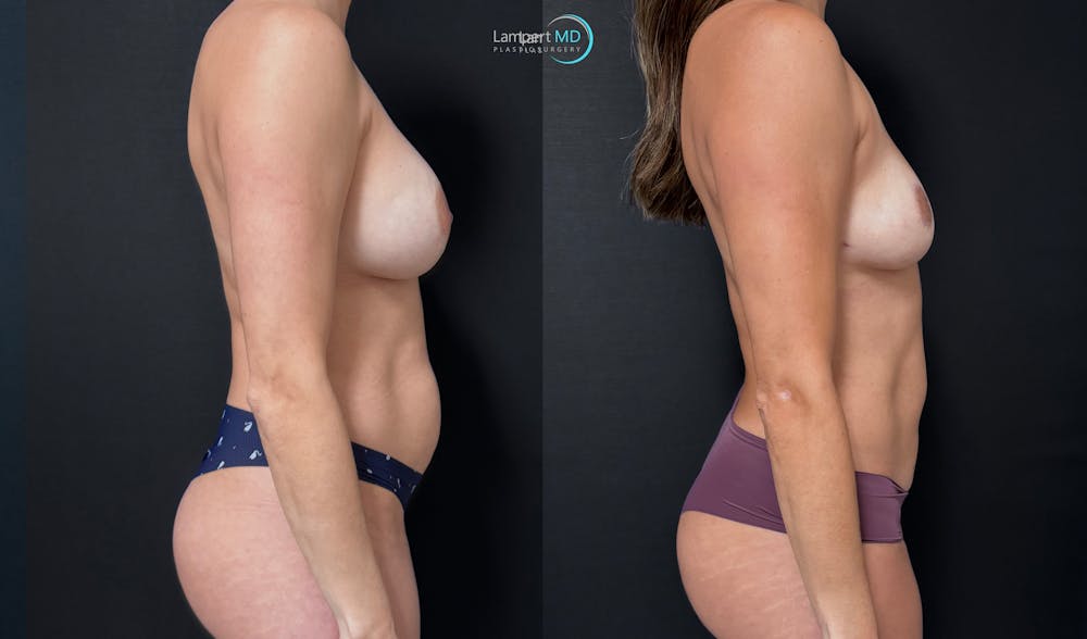 Breast Explant Before & After Gallery - Patient 420516 - Image 4