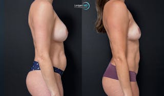 Breast Explant Before & After Gallery - Patient 420516 - Image 4