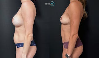 Breast Explant Before & After Gallery - Patient 420516 - Image 5