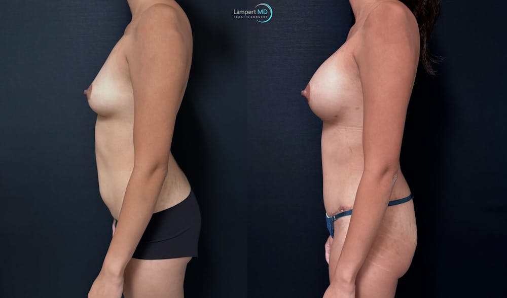 Mommy Makeover Before & After Gallery - Patient 378114 - Image 5