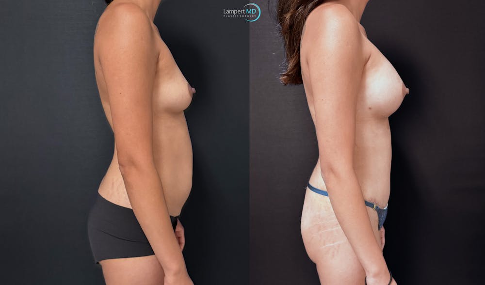 Mommy Makeover Before & After Gallery - Patient 378114 - Image 4