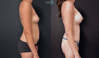 Mommy Makeover Before & After Gallery - Patient 378114 - Image 4