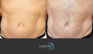 Hernia Repair Abdominal Wall Before & After Gallery - Patient 388860 - Image 3