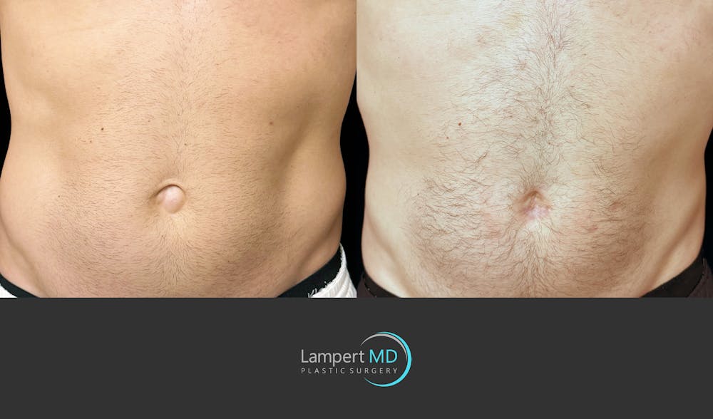Hernia Repair Abdominal Wall Before & After Gallery - Patient 388860 - Image 1