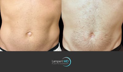 Hernia Repair Abdominal Wall Before & After Gallery - Patient 388860 - Image 1