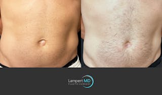 Hernia Repair Abdominal Wall Before & After Gallery - Patient 388860 - Image 2
