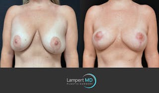 Breast Explant Before & After Gallery - Patient 285061 - Image 2