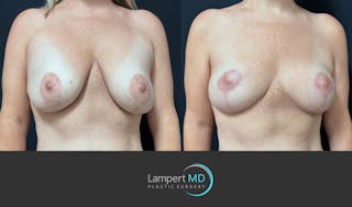 Breast Explant Before & After Gallery - Patient 285061 - Image 3