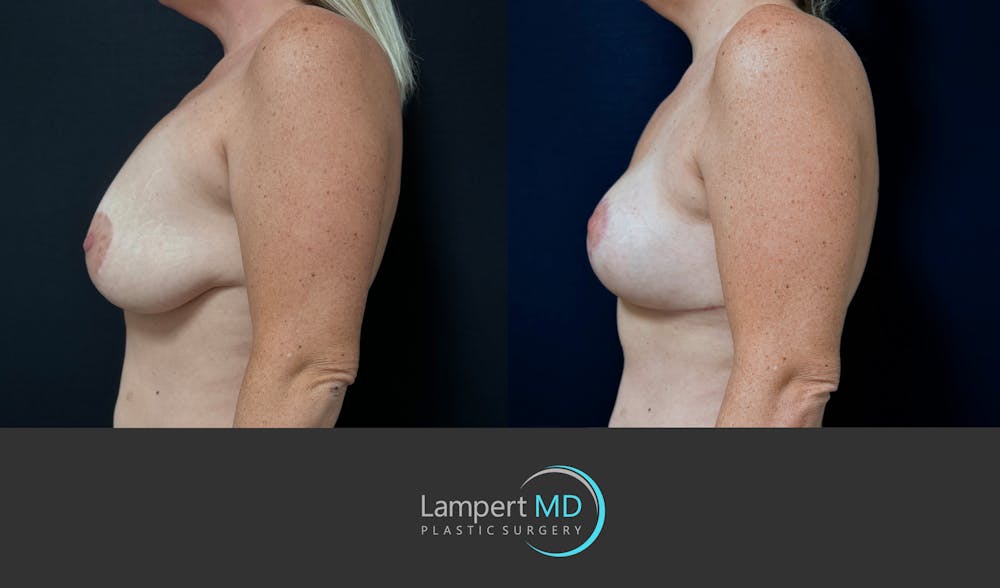 Breast Explant Before & After Gallery - Patient 285061 - Image 5