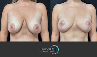Breast Explant Before & After Gallery - Patient 285061 - Image 1