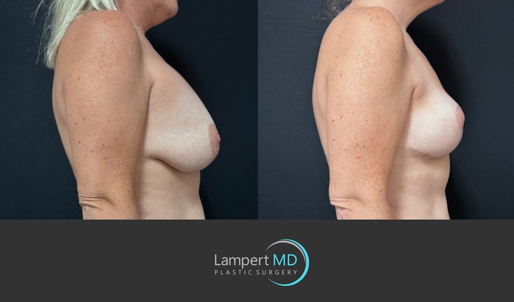 Breast Explant Before & After Gallery - Patient 285061 - Image 4