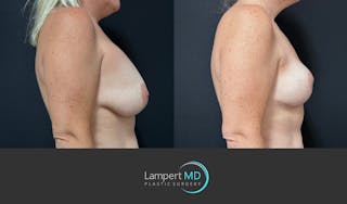 Breast Explant Before & After Gallery - Patient 285061 - Image 4