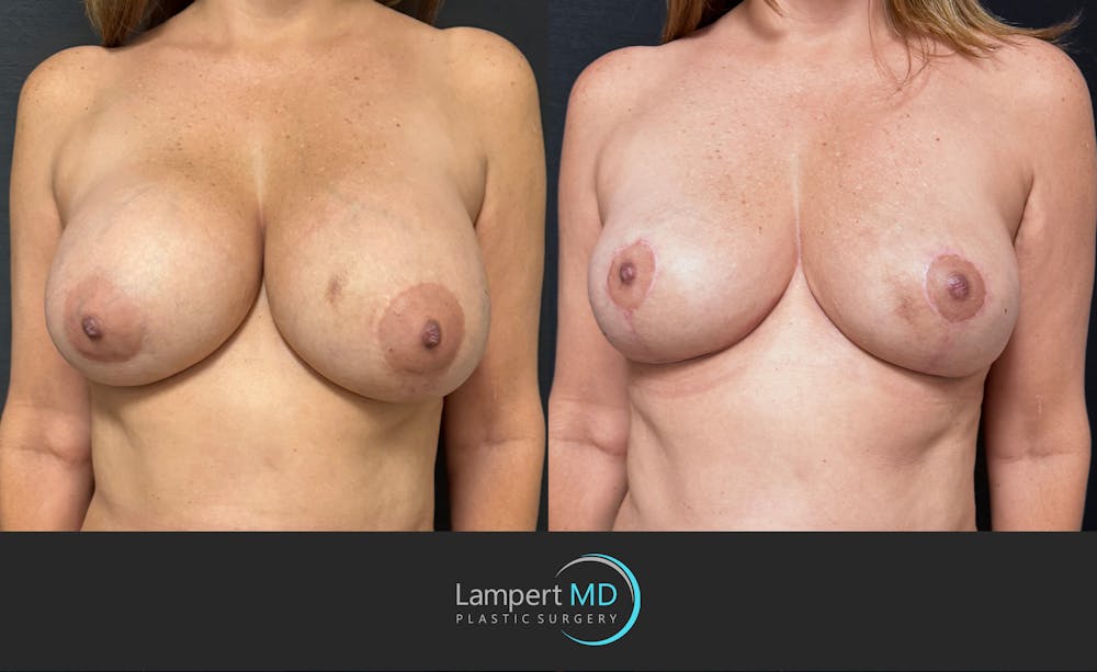 Breast Explant Before & After Gallery - Patient 196697 - Image 3