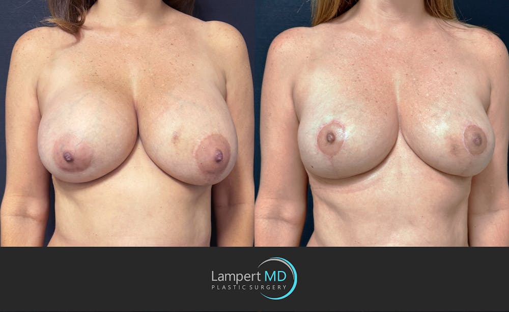 Breast Explant Before & After Gallery - Patient 196697 - Image 2