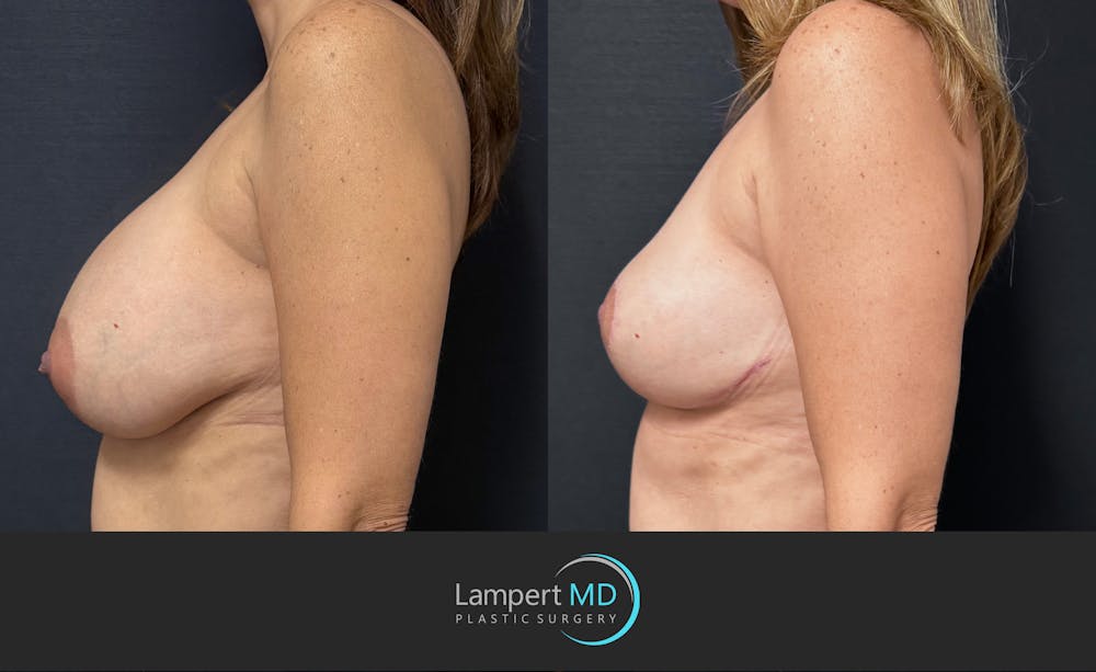 Breast Explant Before & After Gallery - Patient 196697 - Image 5