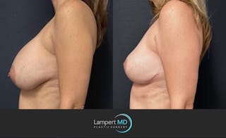 Breast Explant Before & After Gallery - Patient 196697 - Image 5