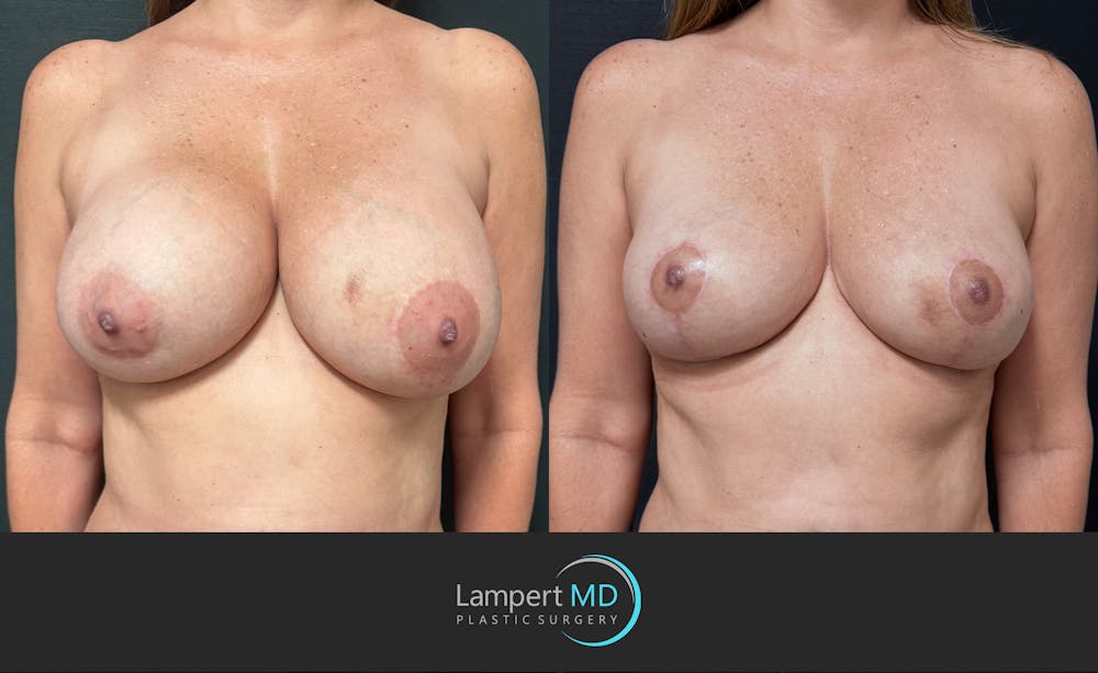 Breast Explant Before & After Gallery - Patient 196697 - Image 1