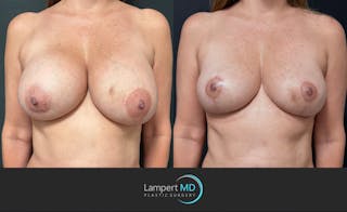 Breast Explant Before & After Gallery - Patient 196697 - Image 1