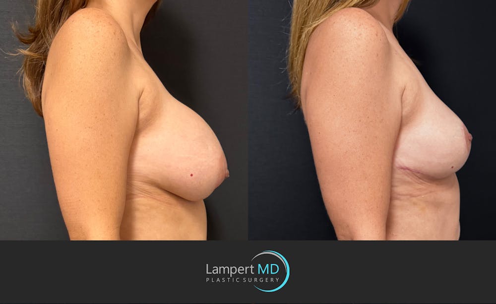 Breast Explant Before & After Gallery - Patient 196697 - Image 4