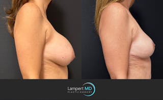 Breast Explant Before & After Gallery - Patient 196697 - Image 4