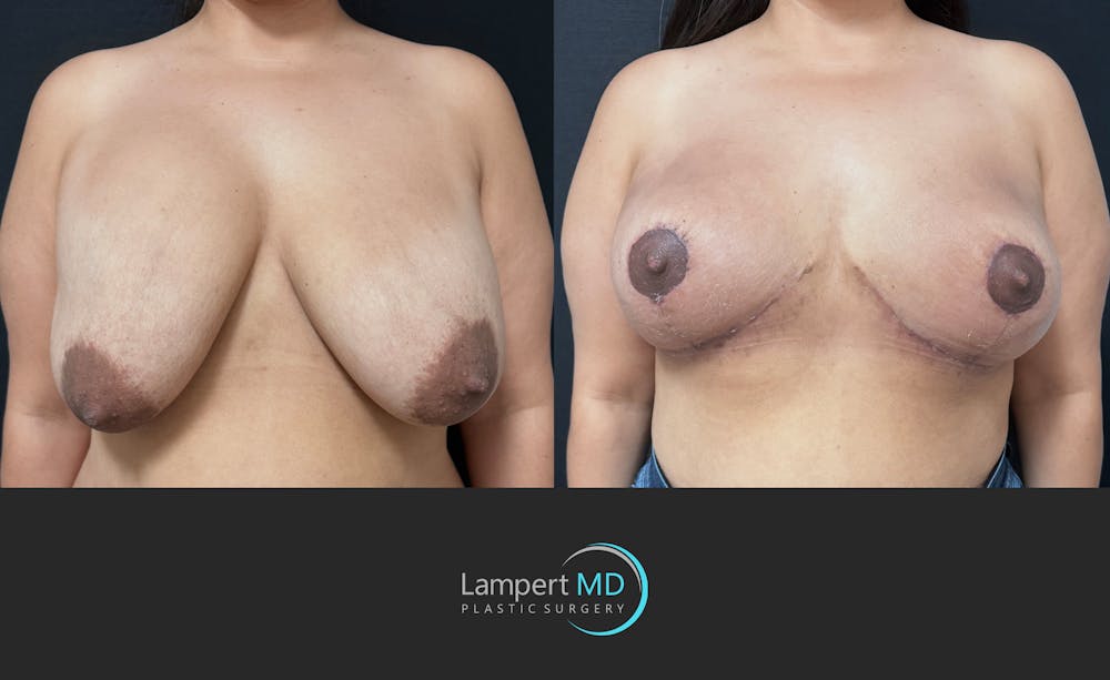 Breast Explant Before & After Gallery - Patient 280811 - Image 1