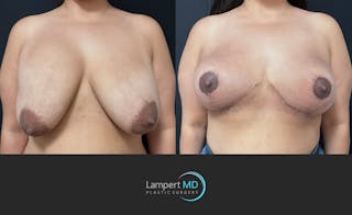 Breast Explant Before & After Gallery - Patient 280811 - Image 1