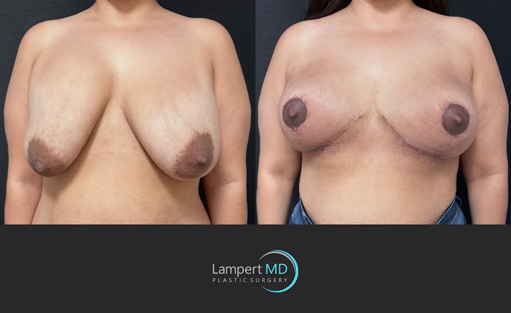 Breast Explant Before & After Gallery - Patient 280811 - Image 3