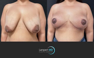 Breast Explant Before & After Gallery - Patient 280811 - Image 3