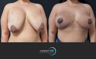 Breast Explant Before & After Gallery - Patient 280811 - Image 2