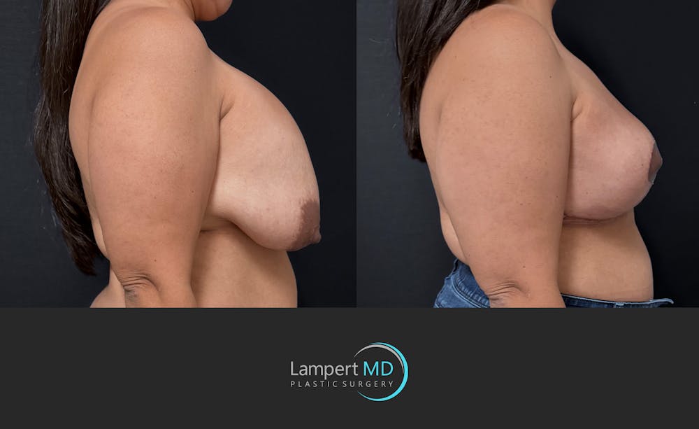Breast Explant Before & After Gallery - Patient 280811 - Image 4