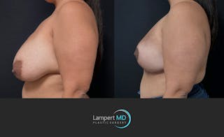 Breast Explant Before & After Gallery - Patient 280811 - Image 5